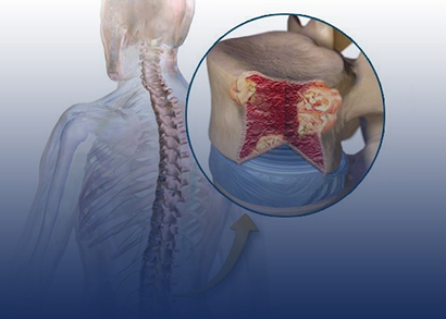 lymphoma image