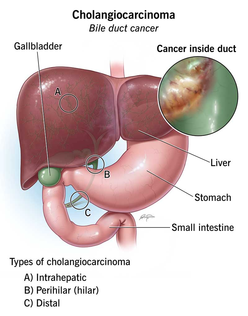 lymphoma image