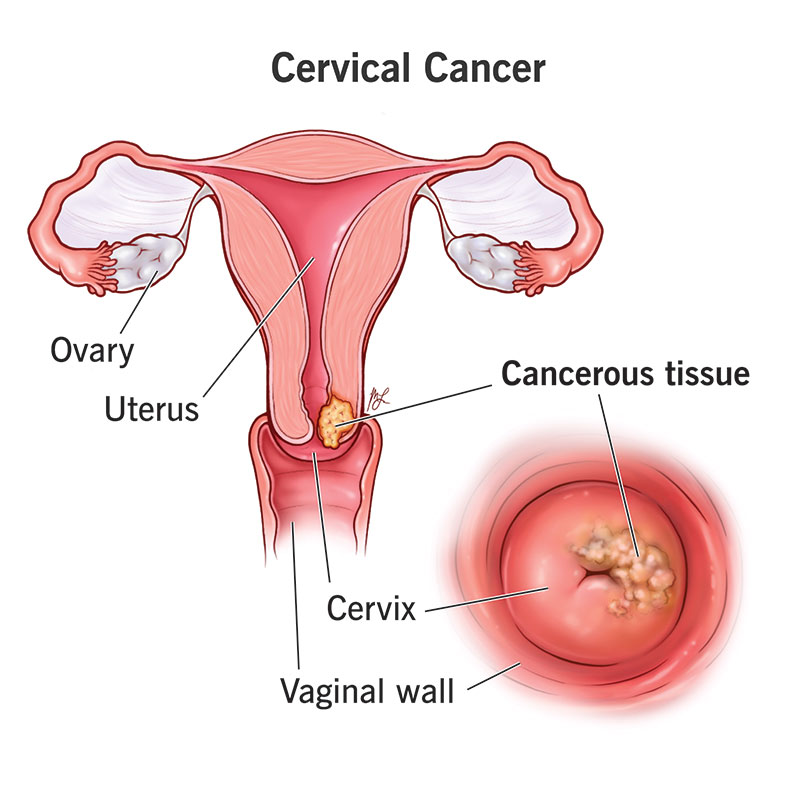 lymphoma image