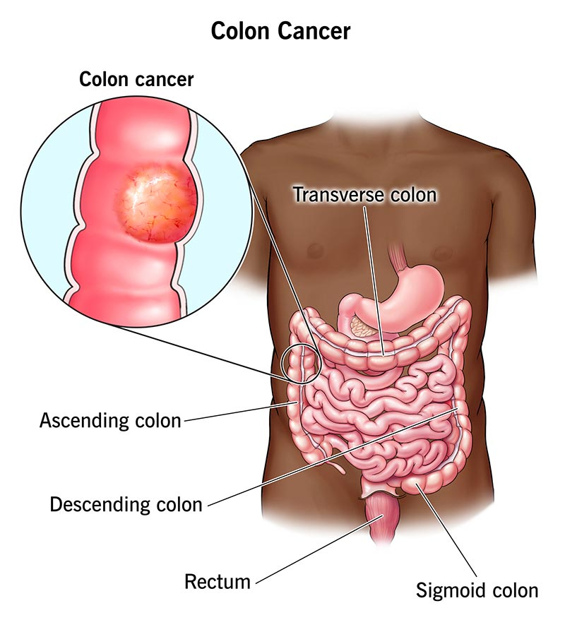 lymphoma image