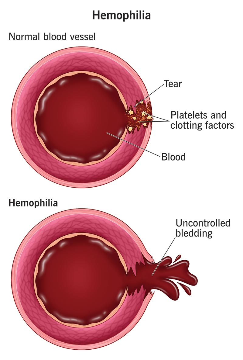 lymphoma image