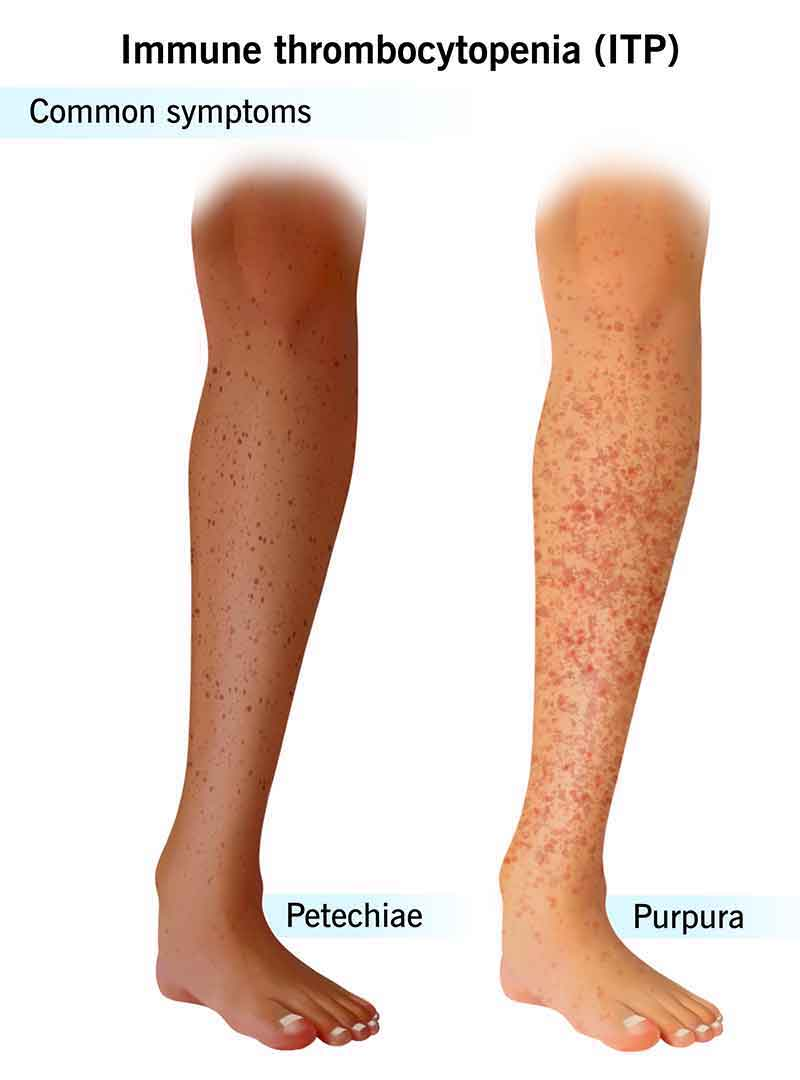 lymphoma image