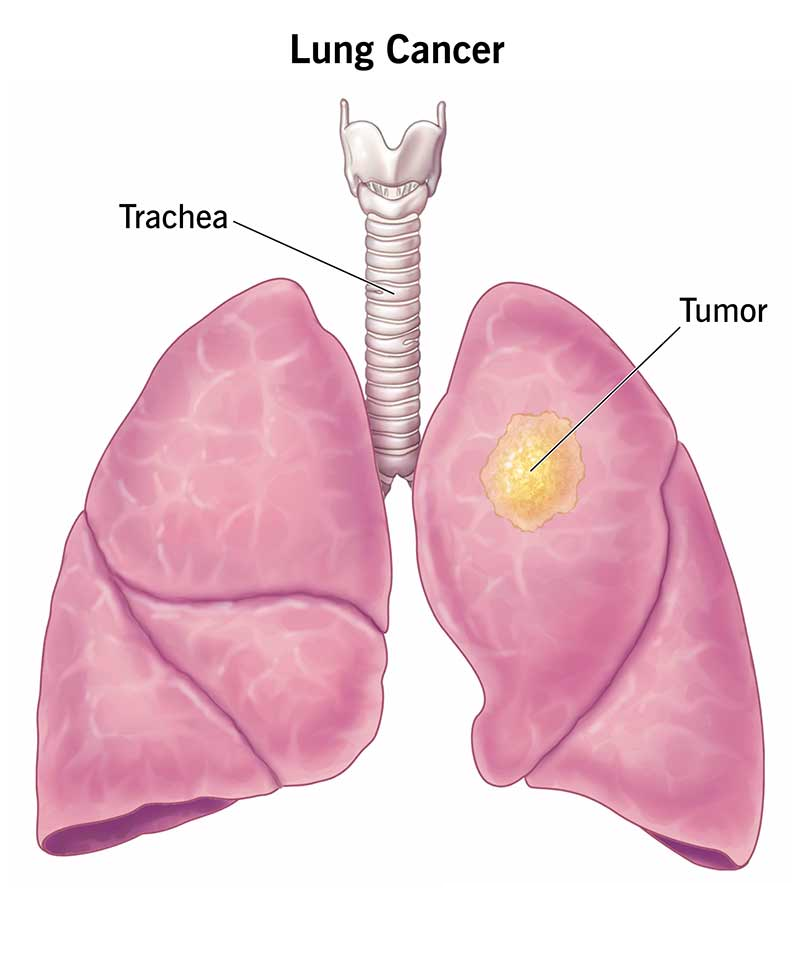 Lung Cancer