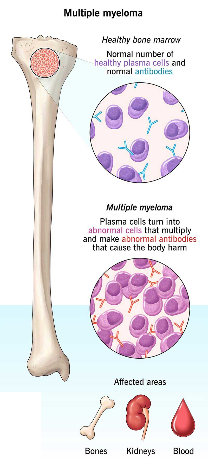 lymphoma image