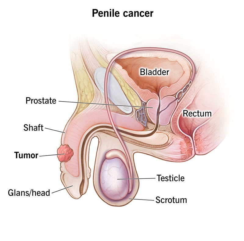 lymphoma image