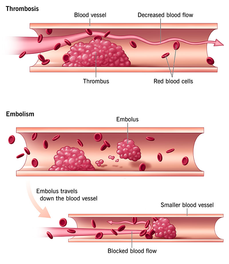 lymphoma image